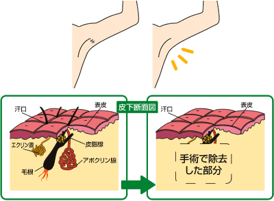 ワキガのメカニズム