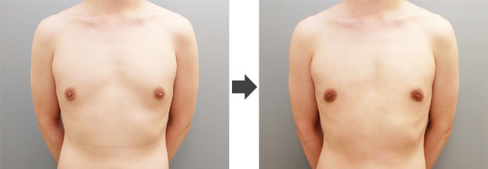 女性化乳房修正術症例№11before-after正面