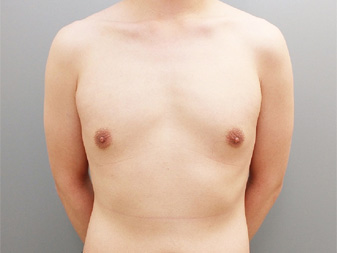 女性化乳房修正術症例№11術前正面