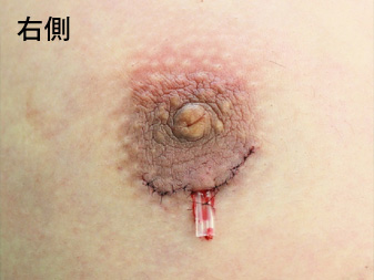女性化乳房修正術症例№11手術直後右側ドレーン挿入の状態