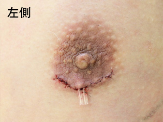 女性化乳房修正術症例№11手術直後左側ドレーン挿入の状態