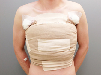 女性化乳房修正術症例№11手術直後正面ガーゼを当てて包帯を巻いた状態