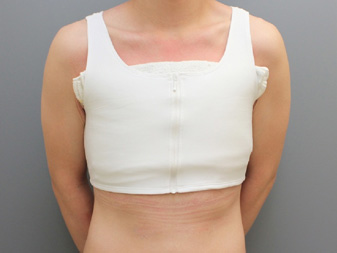 女性化乳房修正術症例№11手術直後正面サポーター着用した状態