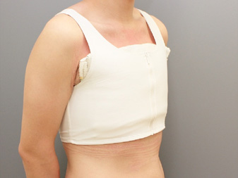 女性化乳房修正術症例№11手術直後右斜めサポーター着用した状態