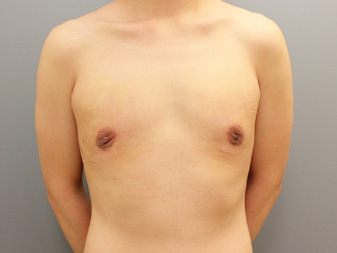女性化乳房修正術症例№11、1週間後正面