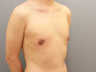 女性化乳房修正術症例№11、1週間後右斜め