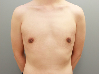 女性化乳房修正術症例№11、1か月後正面