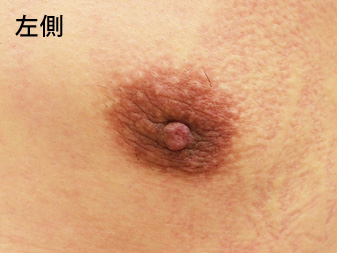 女性化乳房修正術症例№11、1ヶ月後乳輪乳頭の状態左側