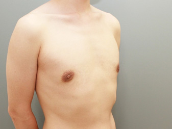 女性化乳房修正術症例№11、3か月後右斜め