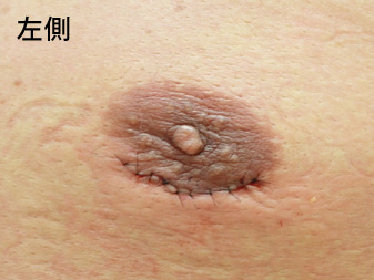 女性化乳房修正術症例№15手術翌日乳輪乳頭の状態左側