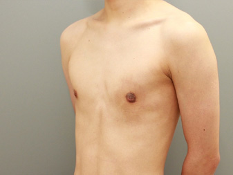 女性化乳房修正術症例№16、1ヶ月後左斜め