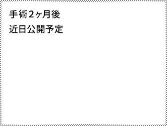 女性化乳房修正術症例№16、2ヶ月後右斜め