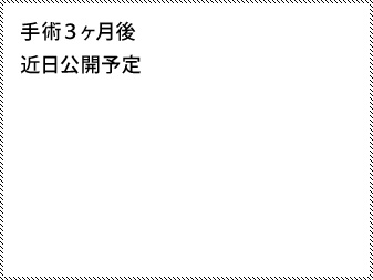 女性化乳房修正術症例№16、3ヶ月後右斜め
