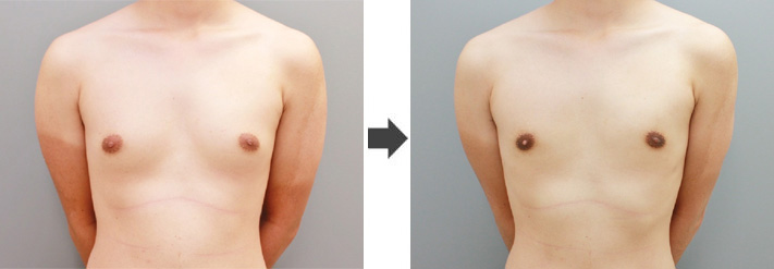 女性化乳房修正術症例№18before-after正面