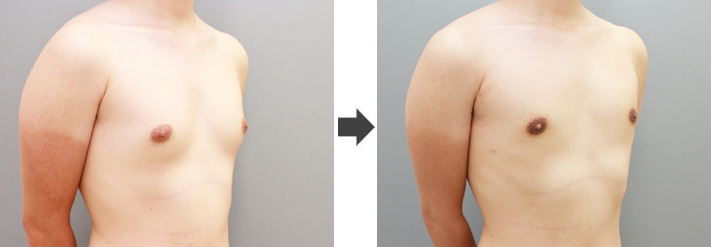 女性化乳房修正術症例№18before-after右斜め