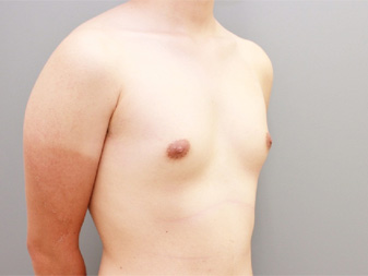女性化乳房修正術症例№18術前右斜め