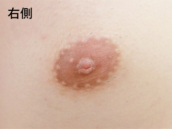 女性化乳房修正術症例№18術前右側乳輪乳頭の状態