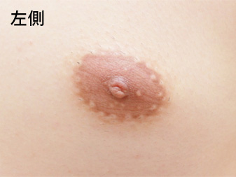 女性化乳房修正術症例№18術前左側乳輪乳頭の状態