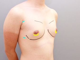 女性化乳房修正術症例№18術前手術デザイン右斜め