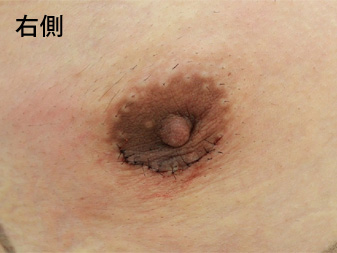女性化乳房修正術症例№18手術翌日乳輪乳頭の状態右側