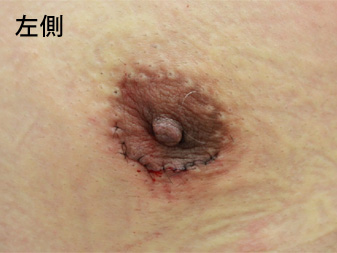 女性化乳房修正術症例№18手術翌日乳輪乳頭の状態左側