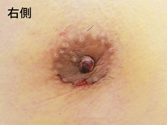 女性化乳房修正術症例№18、1週間後乳輪乳頭の状態右側