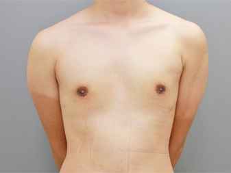 女性化乳房修正術症例№18、2週間後正面
