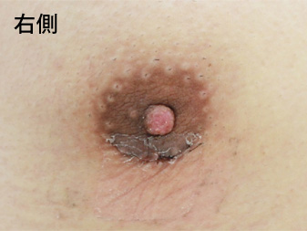 女性化乳房修正術症例№18、2週間後乳輪乳頭の状態右側