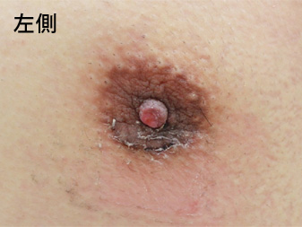 女性化乳房修正術症例№18、2週間後乳輪乳頭の状態左側