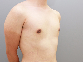 女性化乳房修正術症例№18、1か月後右斜め