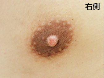 女性化乳房修正術症例№18、2ヶ月後乳輪乳頭の状態右側