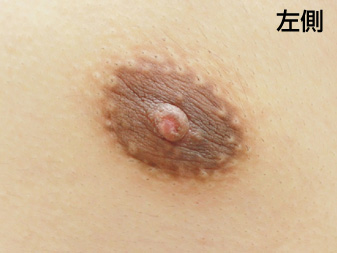 女性化乳房修正術症例№18、2ヶ月後乳輪乳頭の状態左側