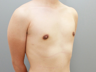 女性化乳房修正術症例№18、3か月後右斜め