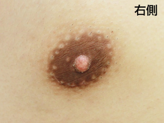 女性化乳房修正術症例№18、3ヶ月後乳輪乳頭の状態右側