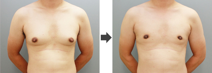 女性化乳房修正術症例№19before-after正面