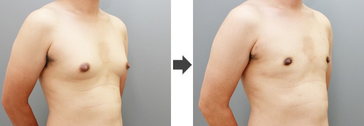 女性化乳房修正術症例№19before-after右斜め