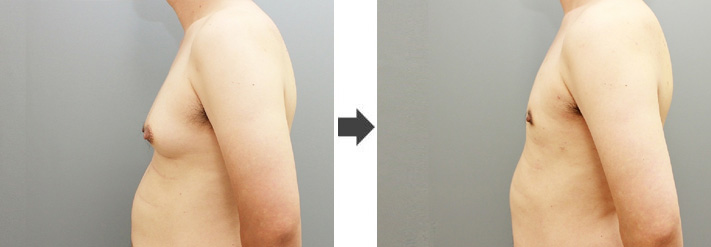 女性化乳房修正術症例№19before-after左向き