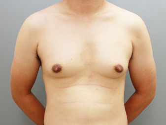 女性化乳房修正術症例№19術前正面