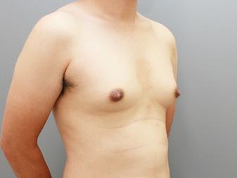 女性化乳房修正術症例№19術前右斜め