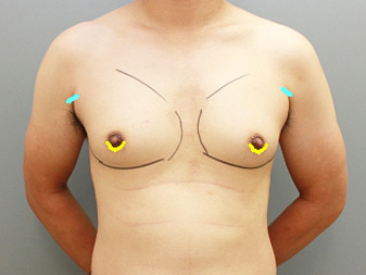 女性化乳房修正術症例№19術前手術デザイン正面