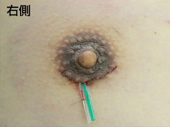 女性化乳房修正術症例№19手術直後右側ドレーン挿入の状態