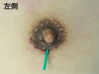 女性化乳房修正術症例№19手術直後左側ドレーン挿入の状態