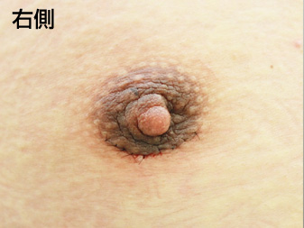 女性化乳房修正術症例№19手術翌日乳輪乳頭の状態右側