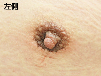 女性化乳房修正術症例№19手術翌日乳輪乳頭の状態左側