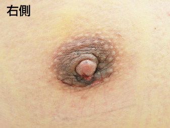 女性化乳房修正術症例№19、1週間後乳輪乳頭の状態右側