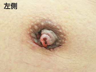 女性化乳房修正術症例№19、1週間後乳輪乳頭の状態左側