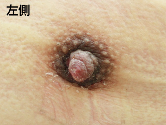 女性化乳房修正術症例№19、2週間後乳輪乳頭の状態左側