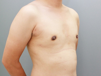 女性化乳房修正術症例№19、1か月後右斜め