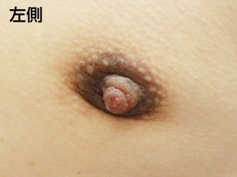 女性化乳房修正術症例№19、1ヶ月後乳輪乳頭の状態左側