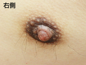 女性化乳房修正術症例№19、3ヶ月後乳輪乳頭の状態右側